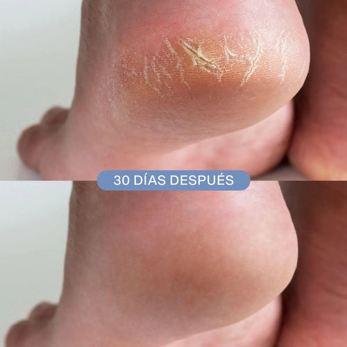 CRACKED HEEL